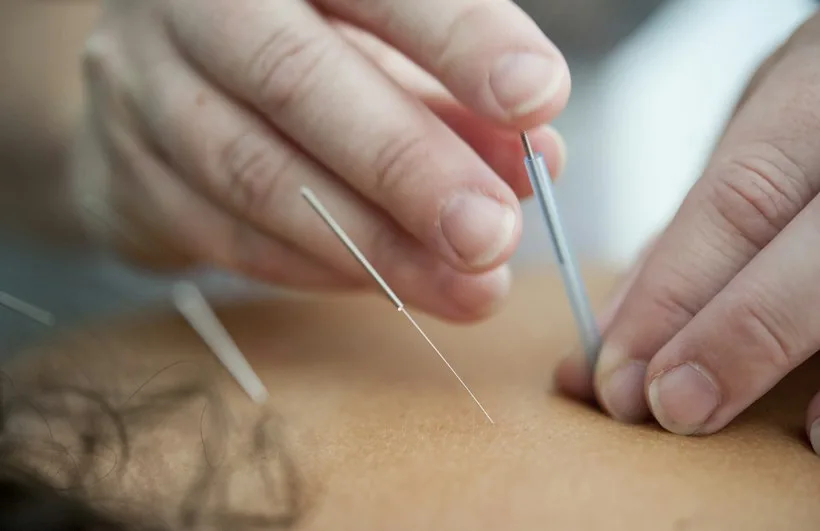 Acupuncture needle placement on a patient's lower back, representing Medicare acupuncture billing for chronic low back pain